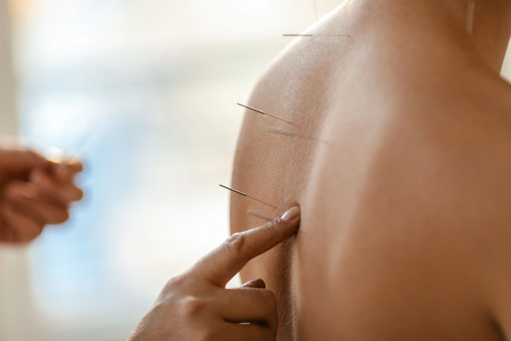 Curious About Dry Needling?