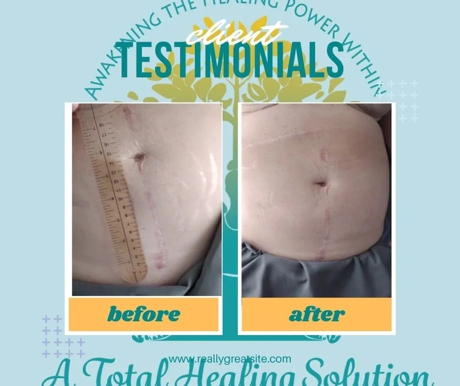 How can Dry Needling Help with Old Injuries and Scars?